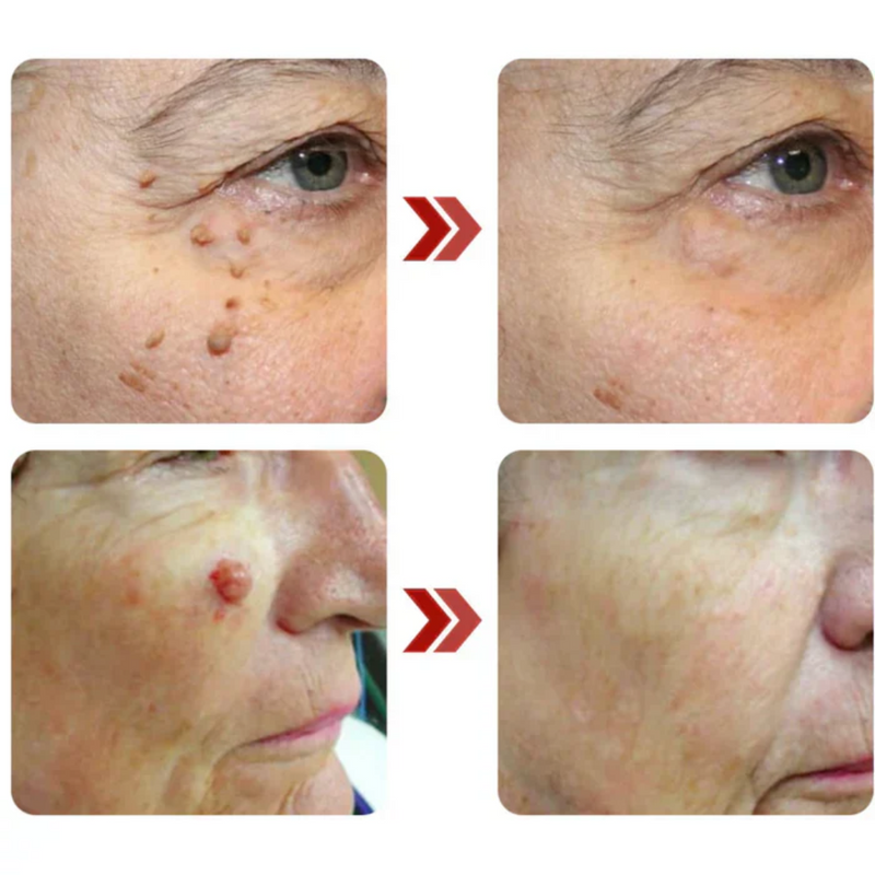 Removix® - Remova Verrugas, Manchas e Marcas com Rapidez e Eficácia! |COMPRE 1 LEVE 2|